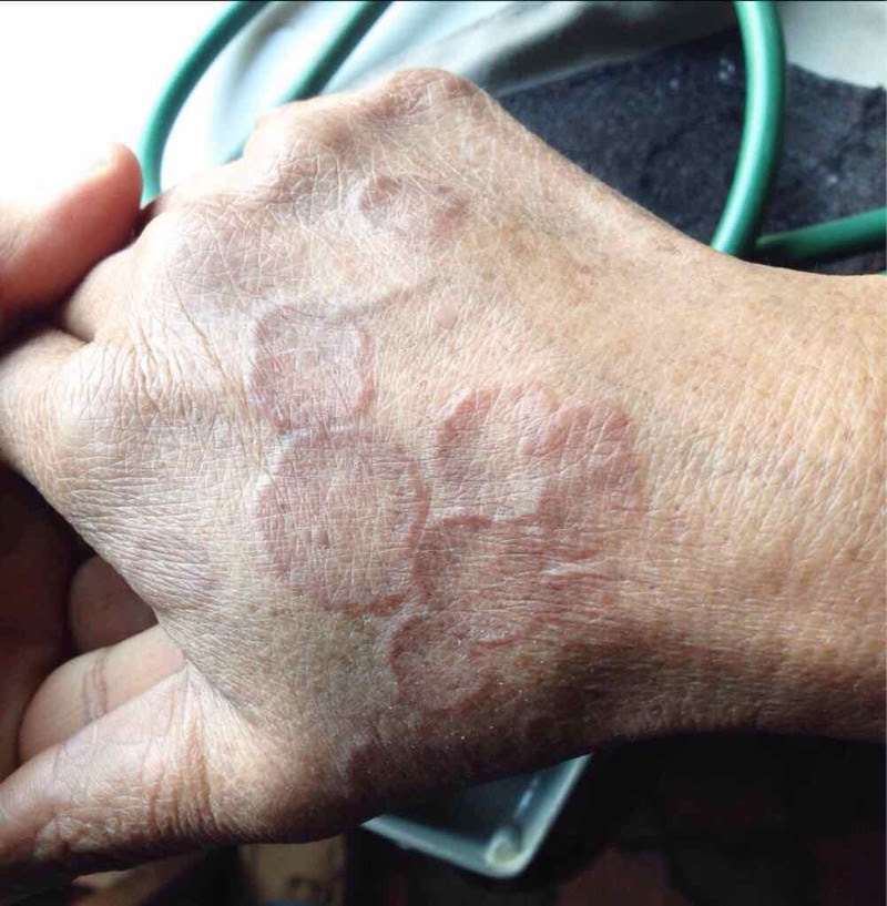 Do you recognize these ring-shaped lesions?